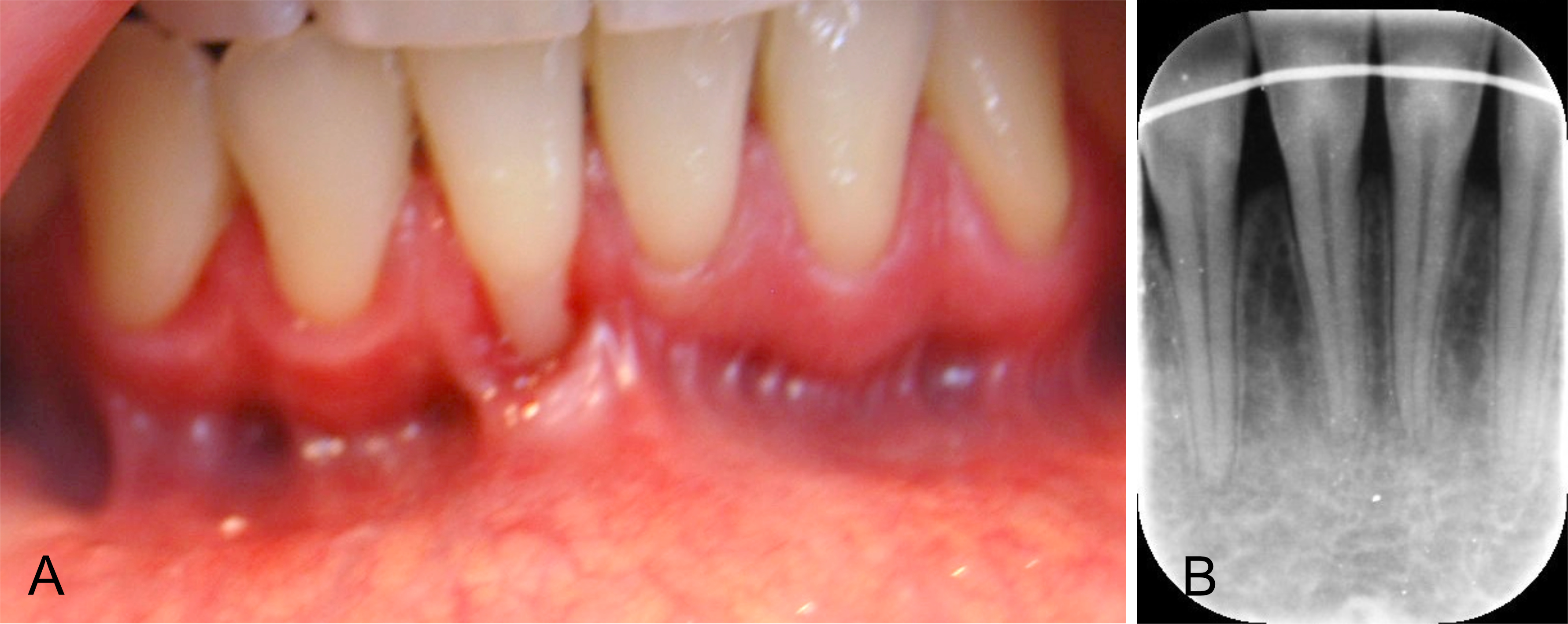 illustrasjon: 2025/04/Kirurgisk-behandling-av-en-gingival-retraksjon-resulterte-i-tykt-bl-tvevsdekke